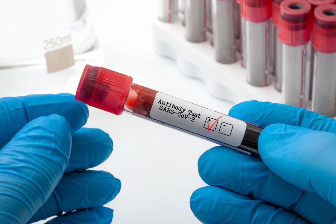 Antibody testing: muddled media reporting has us scratching our heads
